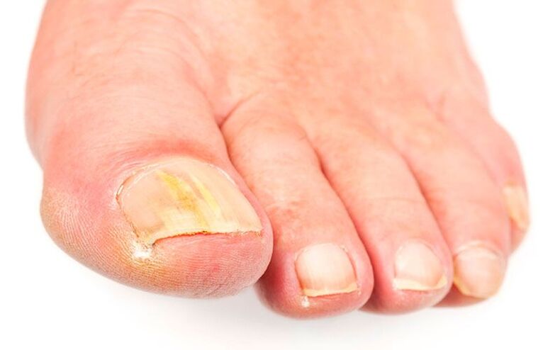 The causes of the mushroom