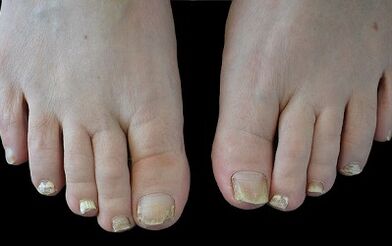 How to get rid of the mushroom on their fingers