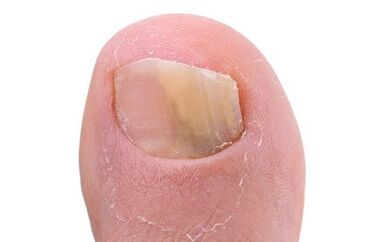 Symptoms of the presence of mushroom on the thumb of the leg