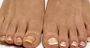 Fleet mushroom treatment methods