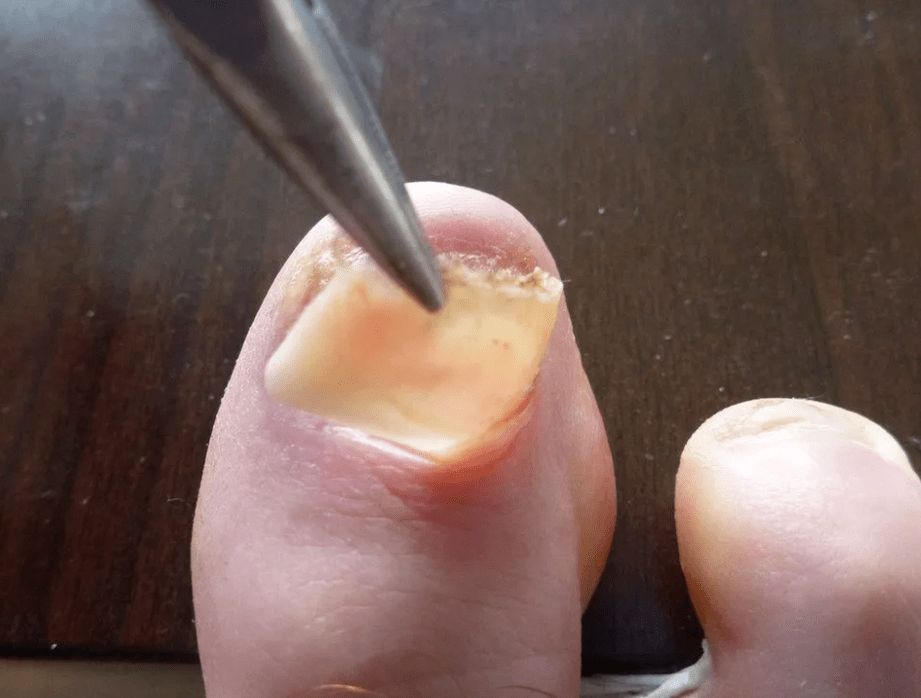 Distance of the plate