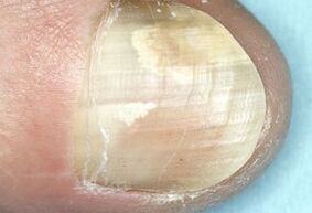 Damage to the nail plate caused by a fungal infection