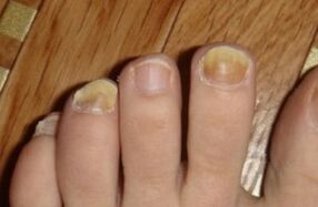 Yellowing of the nail due to fungus