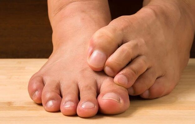 Athlete's foot and remedies for its treatment