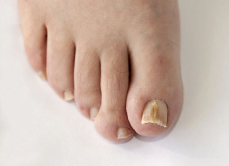 Toenail plate affected by fungus