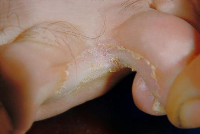 Fungus between toes
