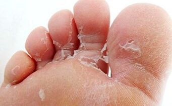 How to treat athlete's foot