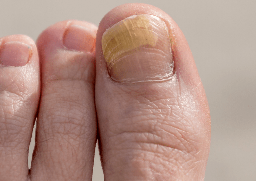 Fungus on big toenail